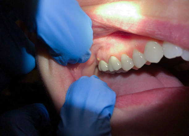 Best Emergency Treatment for Dental Infections or Abscesses in Glen Ridge, NJ